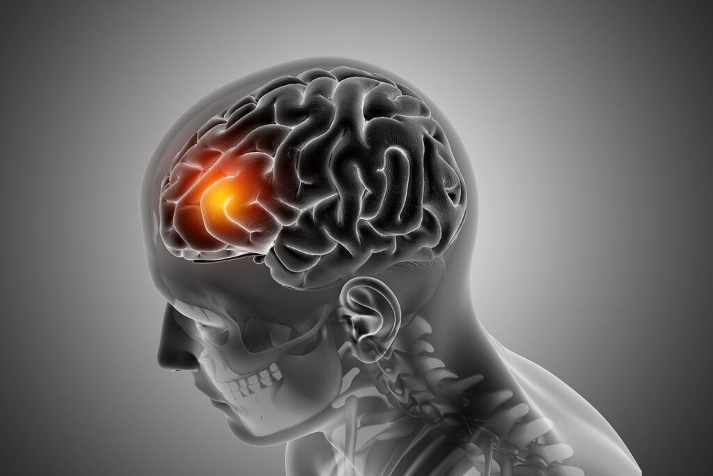 Neurogene spraak- en taalstoornissen